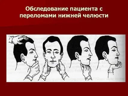 Клинические рекомендации перелом нижней челюсти