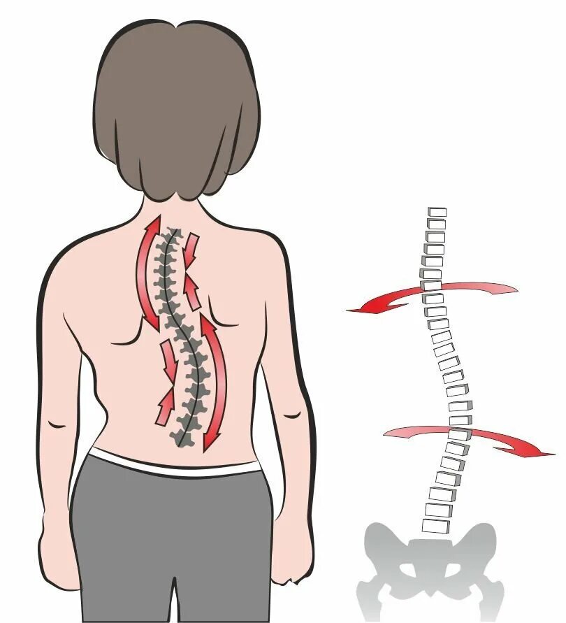 Деформация позвоночника, сколиоз. Позвоночник деформирован сколиоз. S образный сколиоз грудного отдела позвоночника th6 th12. Нуга Бест сколиоз лордоз. Прямой позвоночник без изгибов