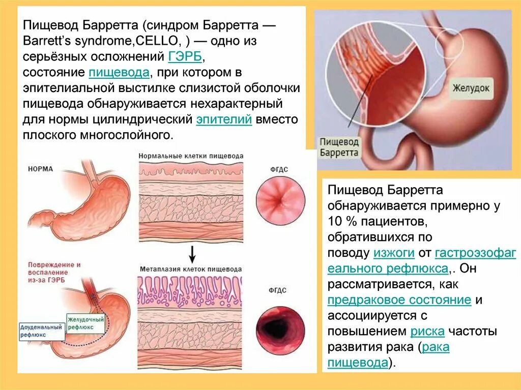 Пищевод баретта