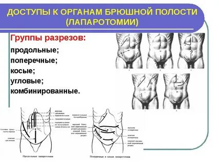 Лапаротомия ревизия