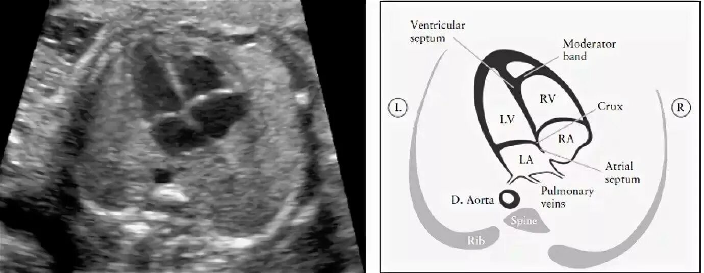 4 Камерный срез сердца у плода. Сердце плода на УЗИ норма. ГЭФ В левом желудочке у плода 20. 4х камерный срез сердца у плода. Четырехкамерный срез сердца
