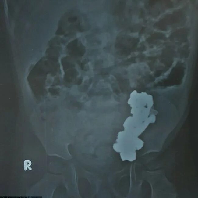 Проглотил большим куском. Магнитные шарики на рентгене. Рентген проглотил монетку. Проглоченная монета в желудке. Монета в желудке у ребенка.
