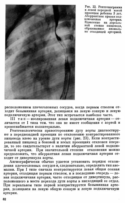 Аберрантная правая подключичная артерия. Аберрантная подключичная артерия у плода. Рентгенодиагностика в педиатрии. Правая аберрантная подключичная артерия у плода.