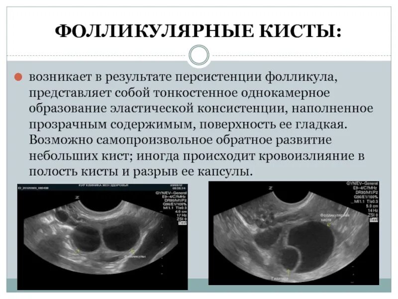 Персистирует фолликул. Персистирующий фолликул яичника узи. фолликулярная киста яичника на узи. функциональная киста яичника на узи. фолликулярная киста яичн.
