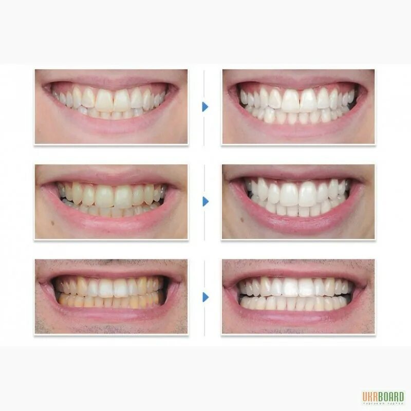 Отбеливание зубов. Профессиональное отбеливание зубов. Этапы отбеливания зубов в стоматологии.