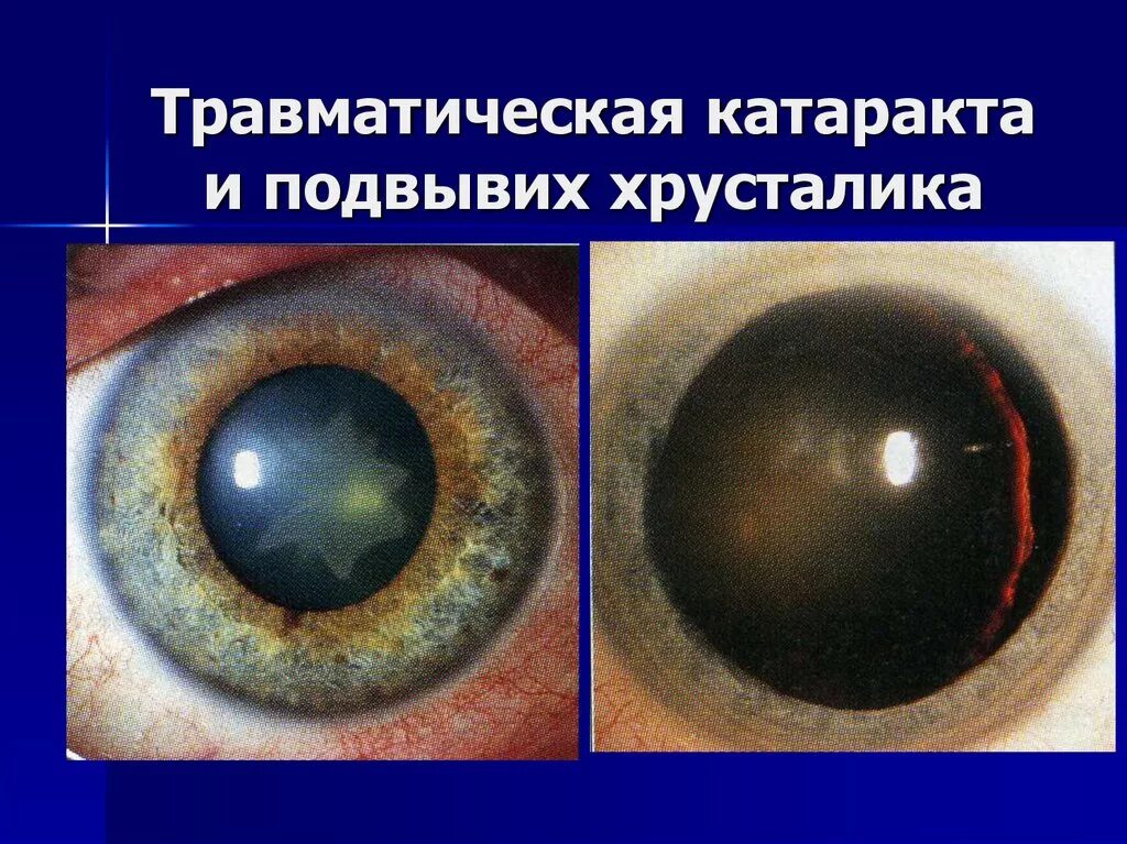 Заболевание и повреждение глаз биология 8 класс. Кольцевидная катаракта Фоссиуса. Сублюксированная катаракта. Гипокальциемическая катаракта. Осложнения катаракта офтальмология.