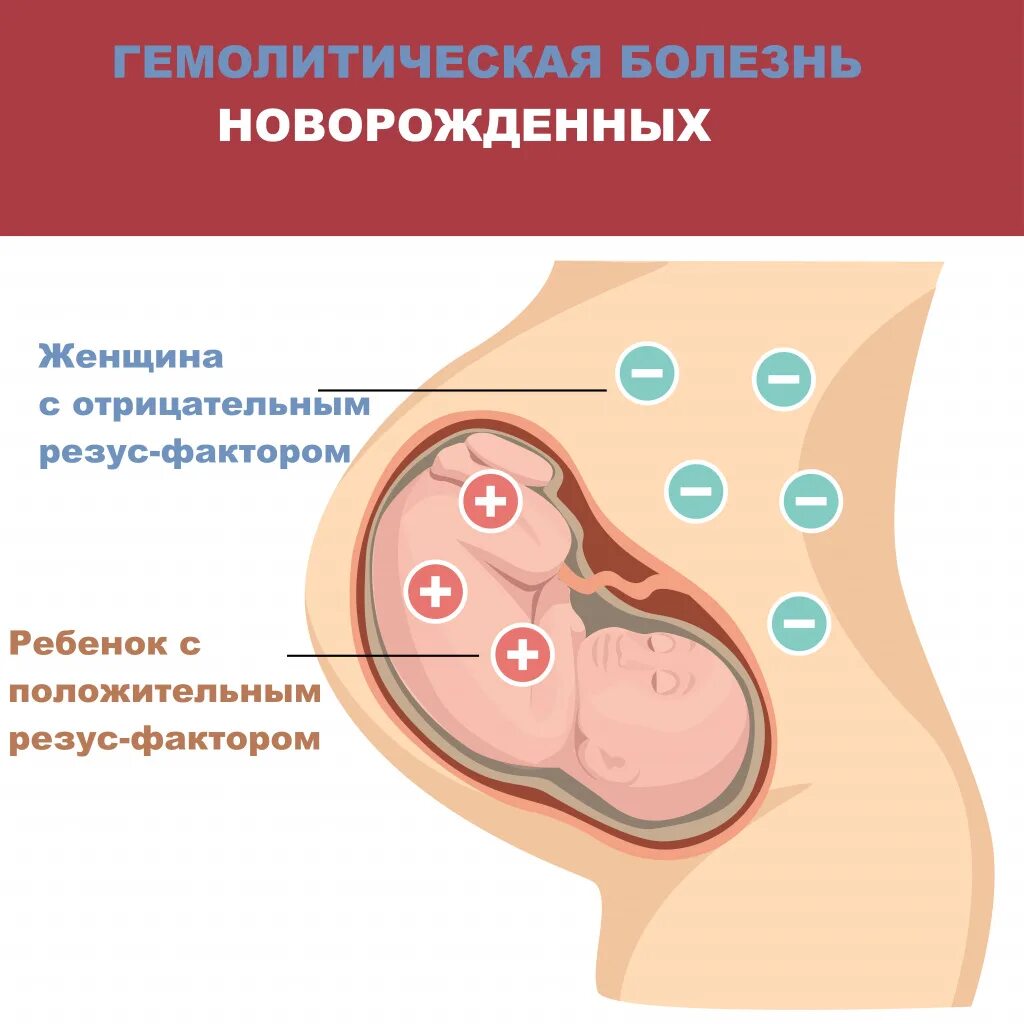 Резус-конфликт при беременности. Резус конфликтная беременность. Схема резус конфликта матери и ребенка. Несовместимость крови матери и плода. Резус фактор у беременных