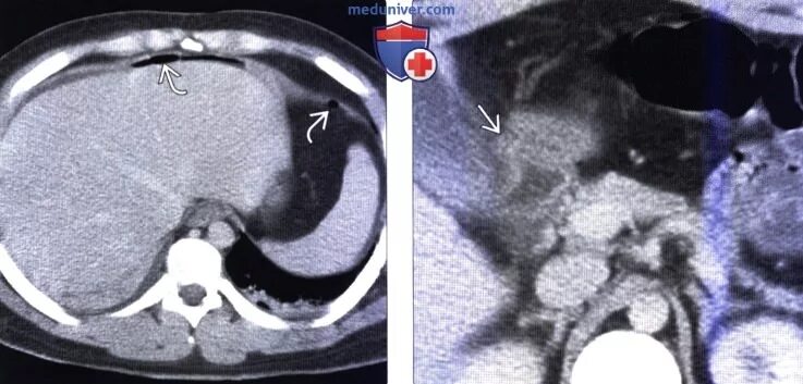 Перфорация язвы желудка на кт. Кт при перфоративной язве. Перфорация язвы ДПК на кт. Язва кт