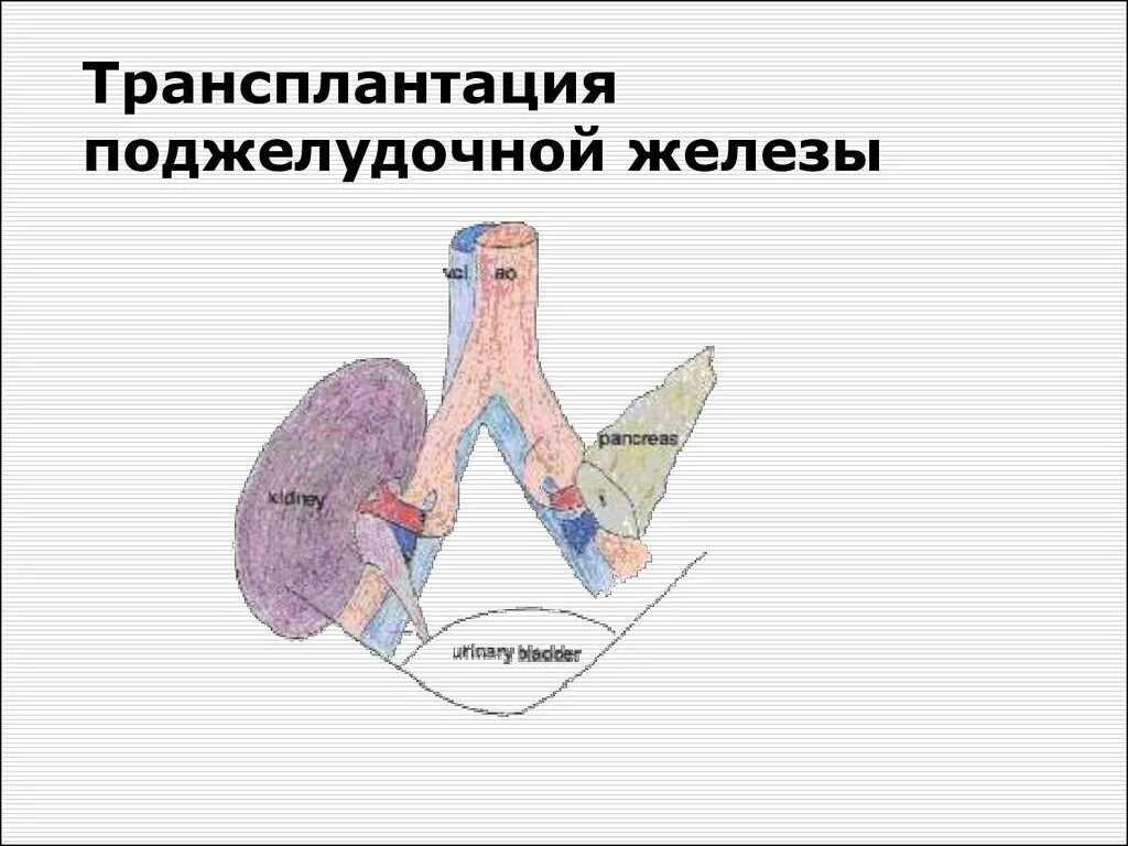 Трансплантация поджелудочной железы. Трансплантология поджелудочной железы. Трансплантация клеток поджелудочной железы. Трансплантация островковых клеток. Пересадка поджелудочной железы при сахарном диабете