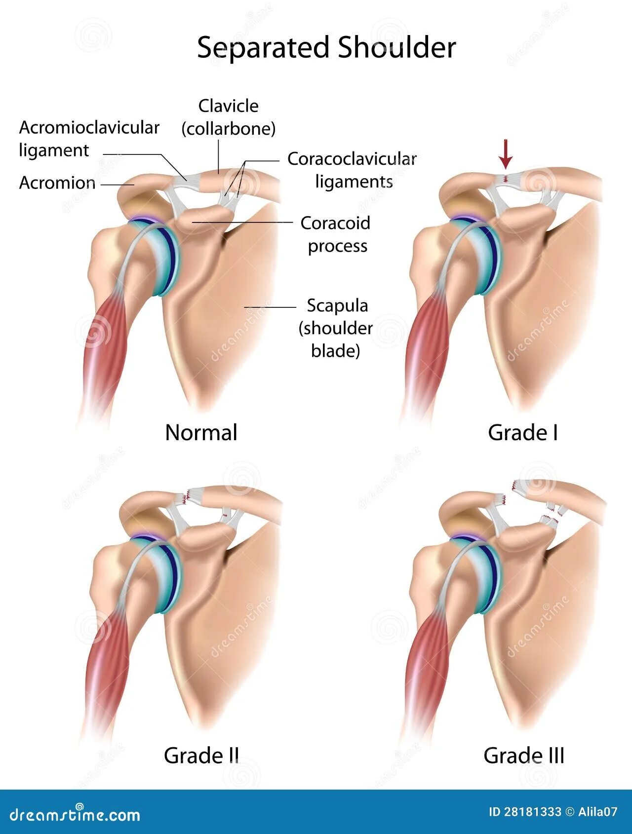 Связка плечевого сустава разорвана. Разрыв ключевых связок плечо. Акромиально-ключичный сустав мышцы. Разрыв акромиального сочленения. Разрыв плечевого сустава симптомы