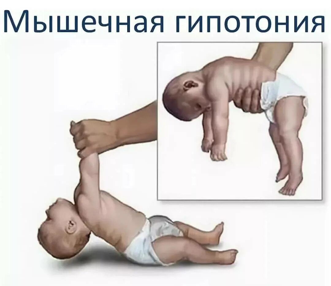 Снижение мышечной