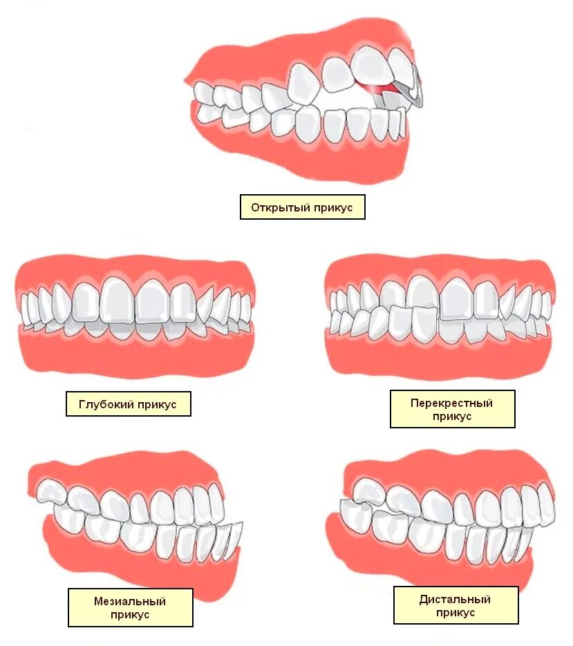 Почему постоянно открыт рот. Правильный прикус вид сбоку. Перекрестный прикус на нижней челюсти. Правильный прикус зубов смыкание зубов. Перекрестный прикус верхней челюсти.