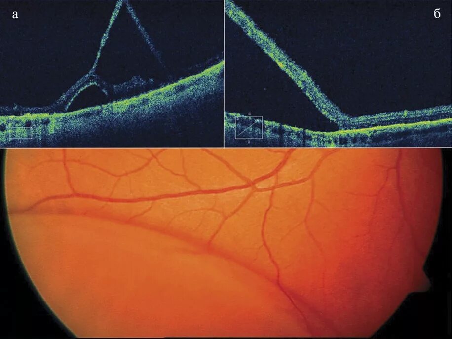Ретиношизис дистрофия сетчатки. Макулярный ретиношизис сетчатки. Ювенильный ретиношизис. Экссудативная отслойка сетчатки.