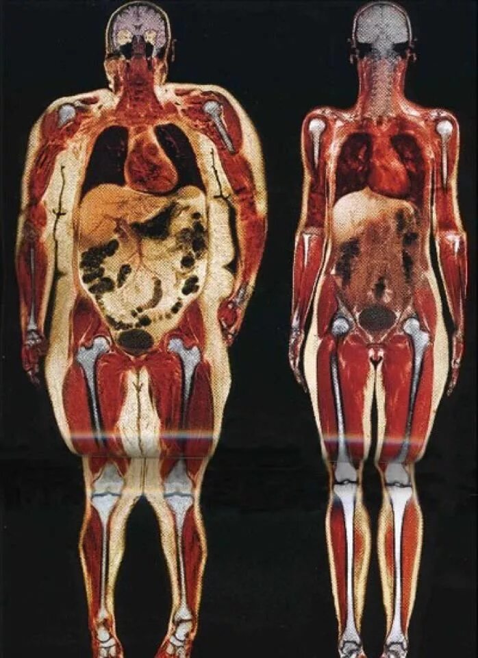 Толстый человек анатомия. Висцеральный жир анатомия. Висцеральный жир рентген. Ожирение висцеральный жир. Широкая кость.