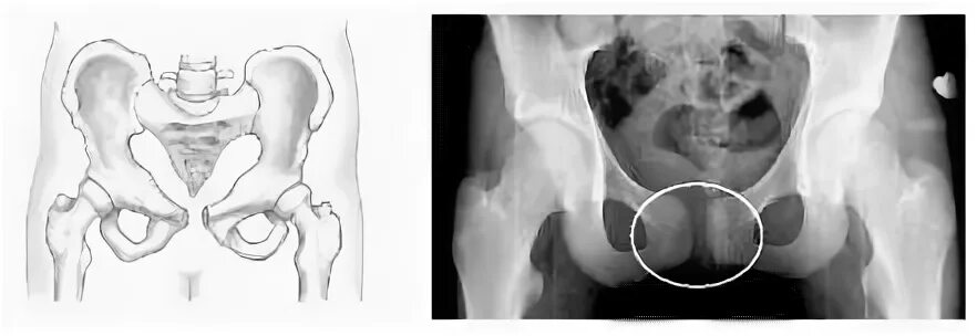 Перелом лонного сочленения рентген. Подвывих лобкового симфиза. Разрыв лонного сочленения рентген. Расхождение лонного сочленения рентген. Расширение таза при беременности