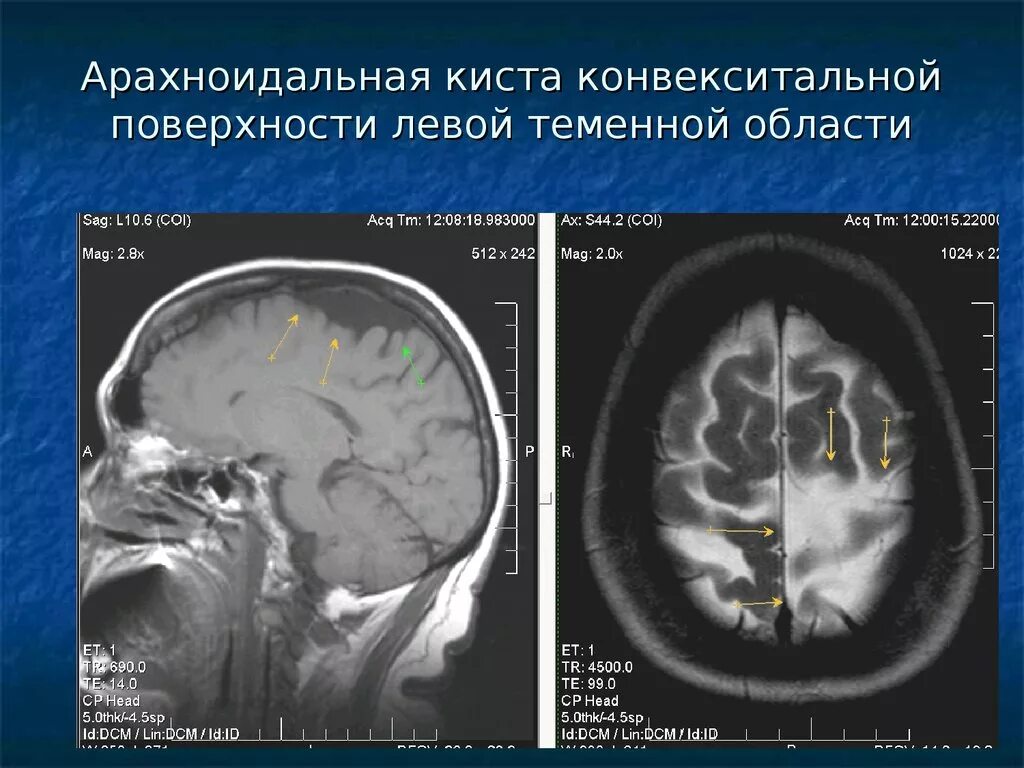 Изменение ликворокистозного характера. Ликворная киста височно теменной области. Мрт головного мозга арахноидальная киста левой височной доли. Арахноидальная киста лобной области мрт. Арахноидальная киста лобной доли мрт.