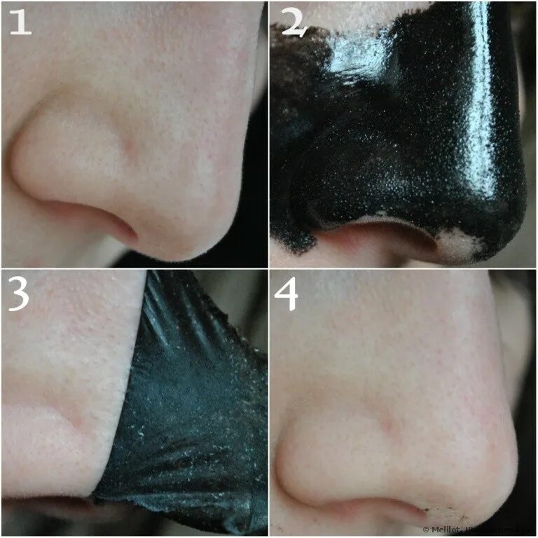 Методы избавления от черных точек. Избавиться от черных точек. Чёрная маска от чёрных точек black mask. Избавление от черных точек. Выдавливание черных точек.