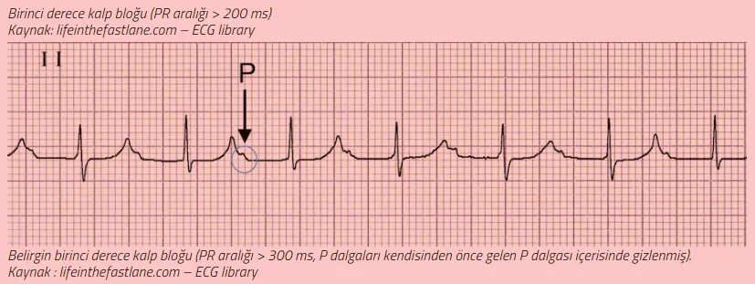 Av Block ECG. Av Block ECG обзор. Волна p300. Atrial–his Interval. Av block remover сайт