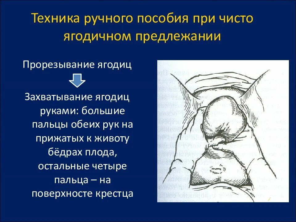 Пособие по цовьянову 2. Ручное пособие по цовьянову при тазовом предлежании. пособие по цовьянову при ягодичном предлежании. ручное пособие по цовьянову при чисто ягодичном предлежании. пособие при ножном предлежании.