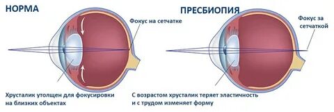 Когда меняют хрусталик глаза