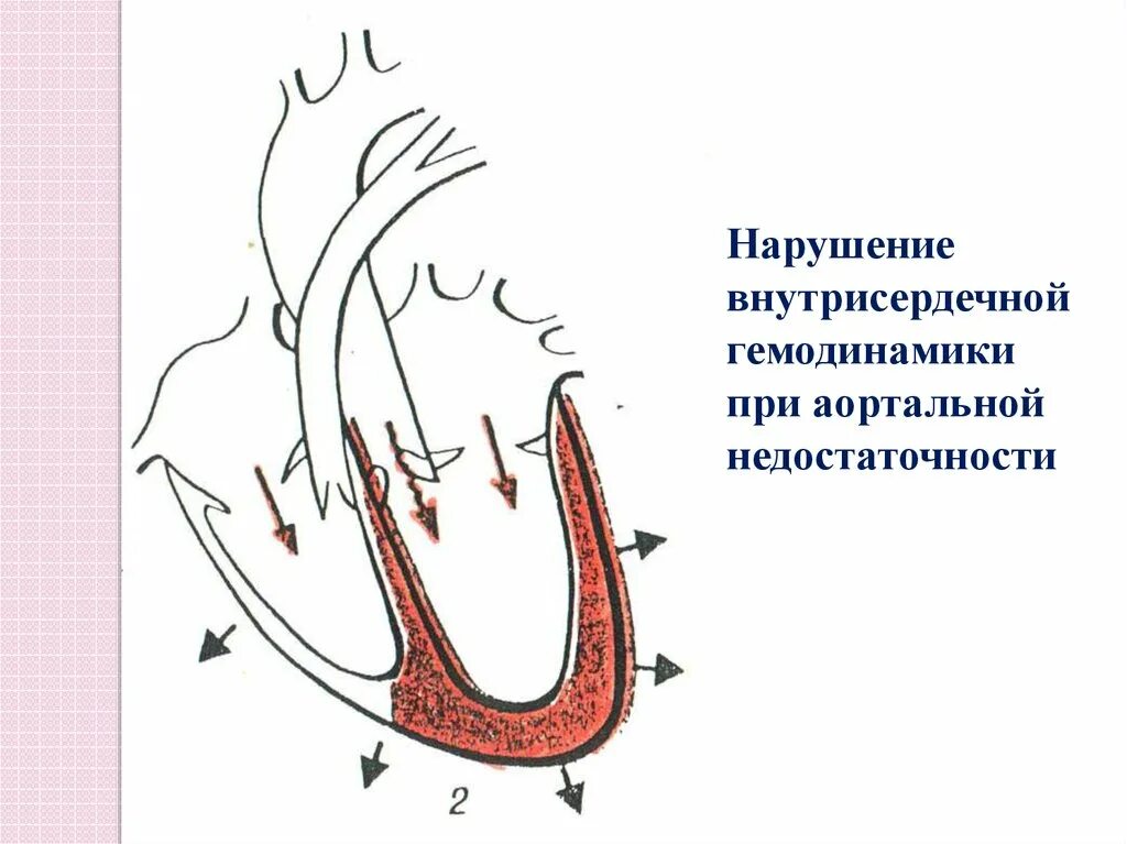 Внутрисердечная гемодинамика. Внутрисердечное давление. Нарушение внутрисердечной гемодинамики. Гемодинамика при аортальной недостаточности.