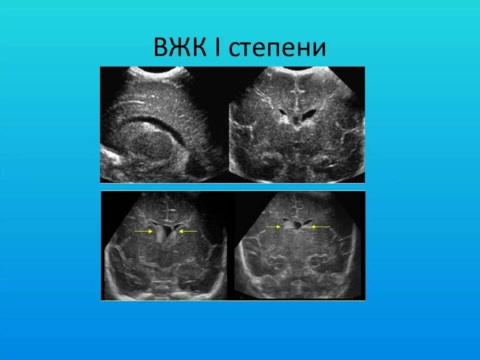 Пвк 1 степени у новорожденных. Внутрижелудочковые кровоизлияния. Классификация внутрижелудочковых кровоизлияний. Внутрижелудочковое кровоизлияние кт. Вжк 4 степени у новорожденных.