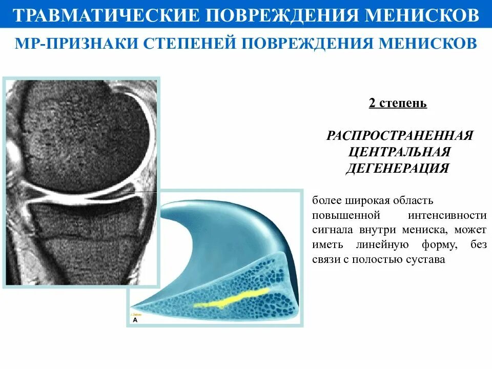 Классификация разрывов мениска. Повреждение менисков коленного сустава классификация. Повреждения менисков мрт классификация. Степени повреждения менисков по Столлеру. Признаки дегенеративных изменений менисков