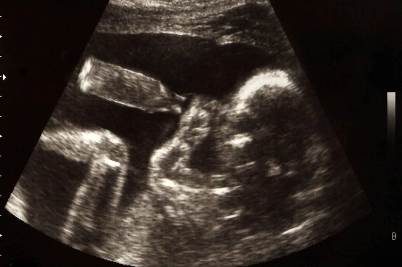 УЗИ двойни на 20 неделе беременности. УЗИ 19 недель беременности двойня. УЗИ ребенка на 20 неделе беременности фото двойня. УЗИ 15 недель беременности двойня.