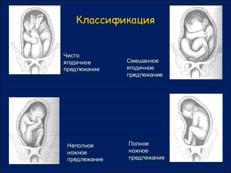 Предлежание плода 2. Неполное ножное предлежание плода. Тазовое ножное предлежание плода. Смешанное тазовое предлежание плода. Продольное головное предлежание 2 позиция.