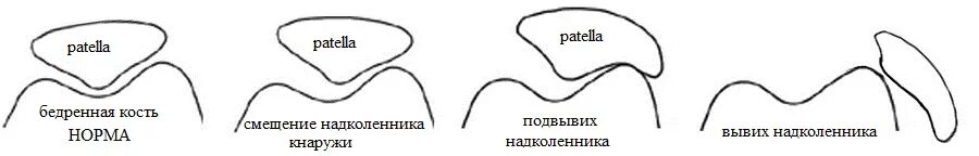 Латерализация надколенника. Вывих надколенника классификация. Смещение надколенника латерально мрт. Дислокация надколенника. Латеральный подвывих коленного сустава рентген.