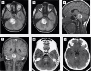 Менингиома доброкачественная. Менингиома на кт. Менингиома мозжечка мрт.