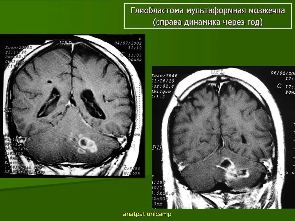 Мультиформная глиобластома. Глиобластома головного мозга. После удаления глиобластомы