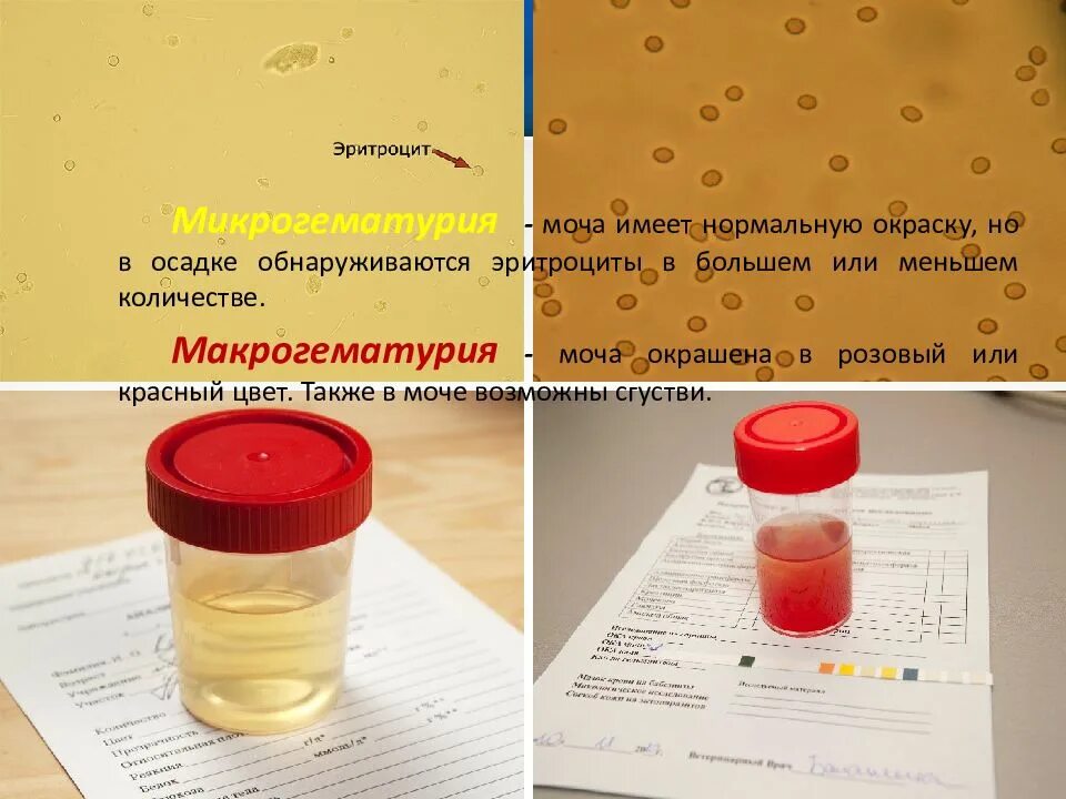 Эритроциты в моче. Измененные эритроциты в моче. Цвет мочи при повышенных эритроцитах. Осадок в моче.