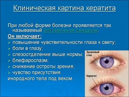 Кератоувеит мкб 10 у взрослых