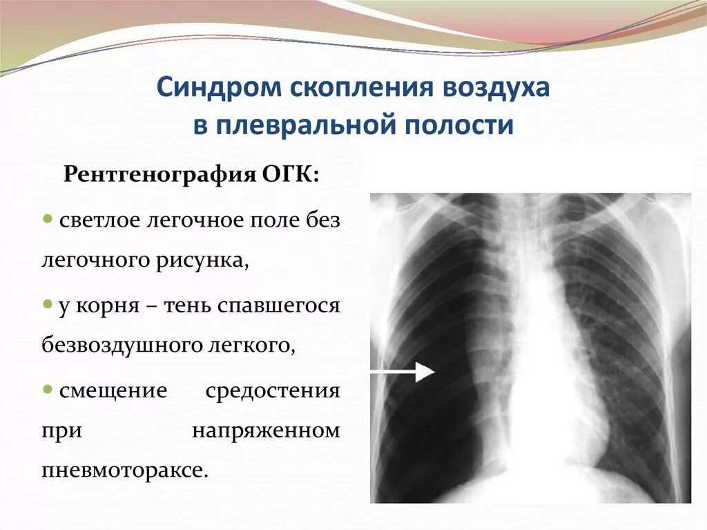 Признаки воздуха в легких. Синдром воздуха в плевральной полости рентген. Синдром скопления воздуха в плевральной полости рентген. Воздух в плевральной полости рентген. Скопление жидкости в плевральной полости рентген.