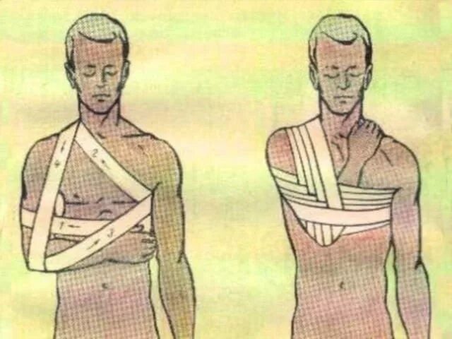 При вывихе плеча применяют повязку спиральную. Иммобилизация повязкой дезо. вывих плечевого сустава повязка дезо. перелом плечевой кости повязка дезо. повязка дезо вывих плеча.