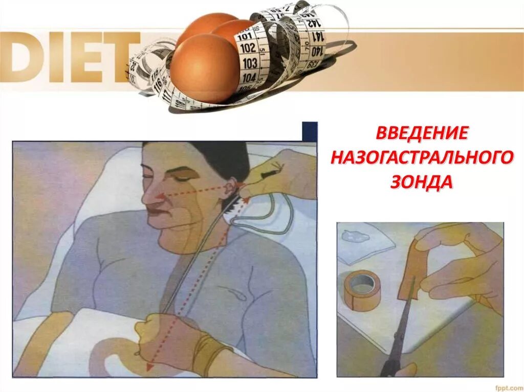 Введение назогастрального зонда алгоритм. Технику введения назогастрального зонда. введение на загастрального зонда. введение зонда алгоритм. техника постановки назогастрального зонда детям.