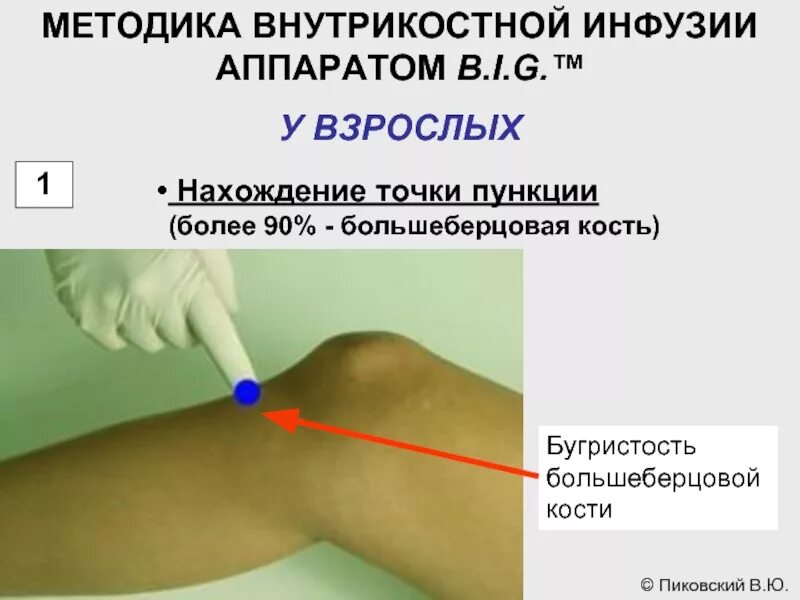 Внутрикостное введение лекарственных. Прибор инфузионный внутрикостный b.i.g. внутрикостное введение место.