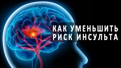 Риск инсульта
