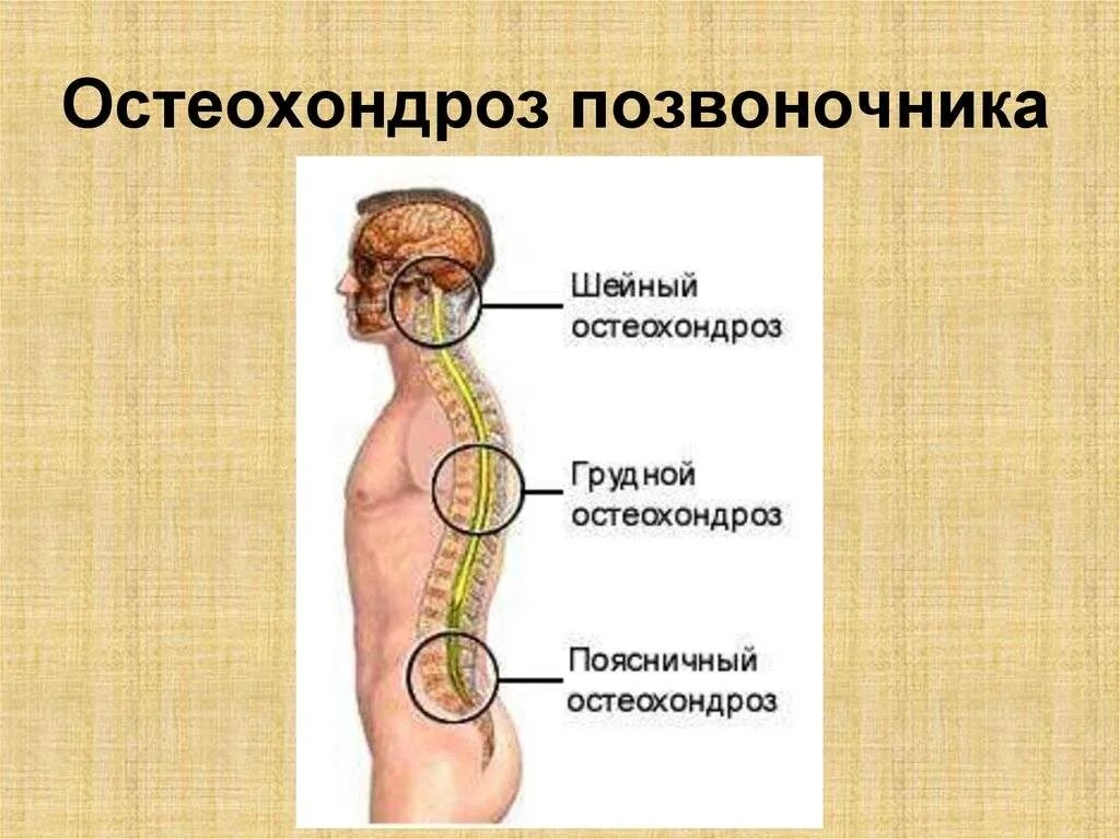 Остеохондроз гоп что это. Остеохондроз. виды остеохондроза. остеохондроз позвоночника. грудной остеохондроз.