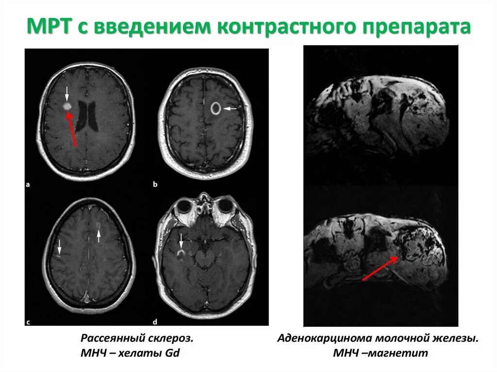 Мрт контрастирование препараты. Контрастные вещества для мрт. Введение контраста при мрт. Магнитно резонансные контрастные средства. Мрт при повышенном пролактине