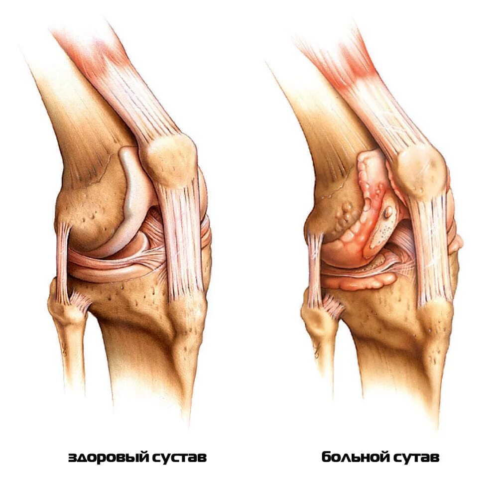 Больные коленные суставы. Ревматоидный артрит коленного сустава. Ревматоидный артрит суставы.