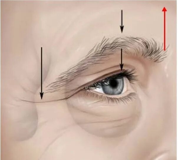 Птоз периорбитальной области. Периорбитальная зона (верхнее и нижнее веко). Край верхнего века