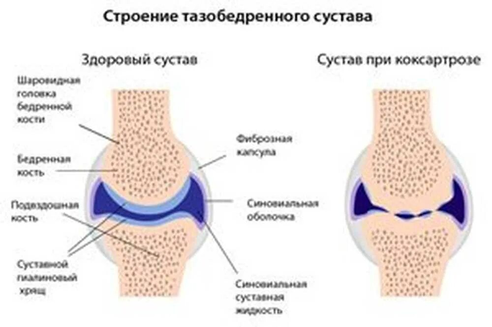 Сустав 1а. Деформирующий артроз схема. Деформирующий остеоартроз синовиальная жидкость. Строение сустава гиалиновый хрящ. Артроз бедренной кости 3 степени.