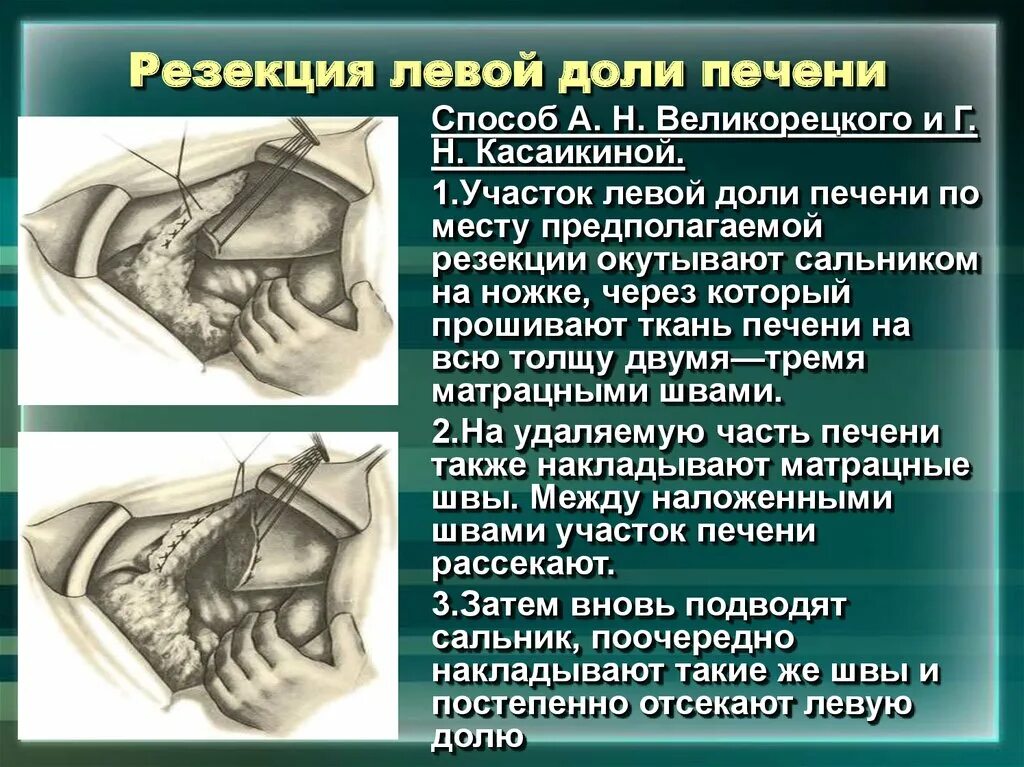 Операция резекция печени. Резекция правой доли печени. Левосторонняя резекция печени.