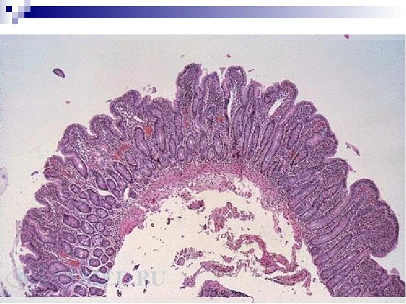 Регенерации слизистой оболочки. Целиакия гистология кишечника. Целиакия микропрепарат. Целиакия гистологическая картина.