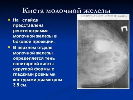 Киста грудины у женщин опасно