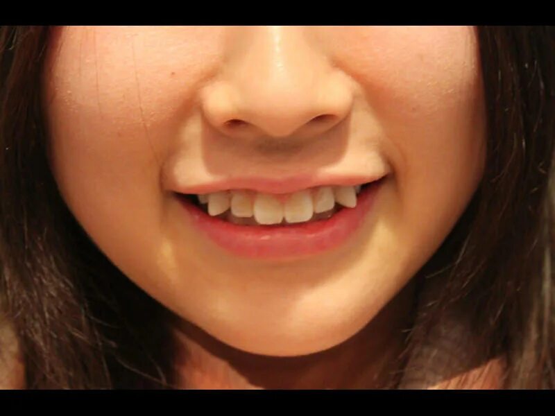 Почему у некоторых людей клыки. Улыбка с крупными зубами. Гипердонтия (сверхкомплектные зубы. Почему у некоторых людей клыки. Улыбка с крупными зубами.