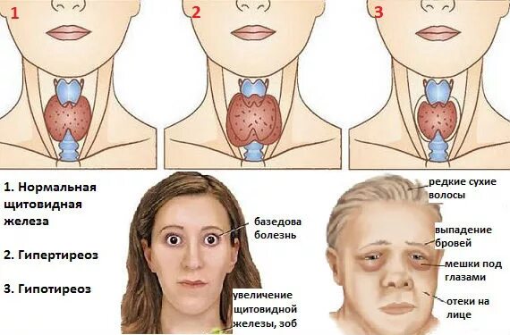 Понижена щитовидная железа