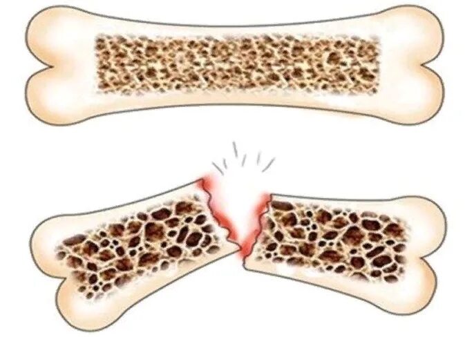 Остеопороз (разрушение костной ткани) наблюдается при:. Остеопороз вымывание кальция. Ювинильный остеопороз. Переломы костей при остеопорозе.